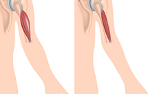 Muscular Dystrophy