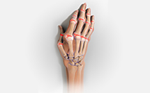 Rheumatoid Arthritis