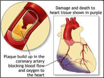 MSCs Treatment in Heart Attack Mesenchymal Stem Cell Therapy in Heart Disease